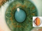 Grade X Defects Of Vision And Their Correction Grade X Defects Of Vision And Their Correction
